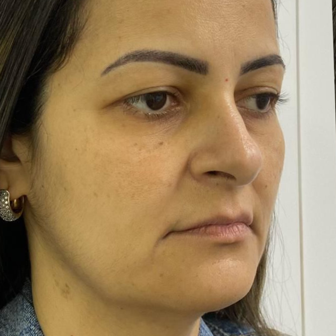 Depois do procedimento